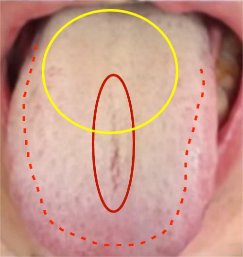 肾虚 + 脾虚 + 湿热 + 肝郁的舌象，是现代人最典型的虚实夹杂、寒热错杂体质