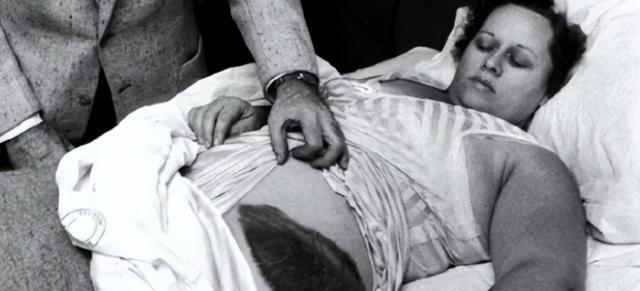 1954年，美国一女子在睡梦中，突然感觉腰部被什么东西蹭着了一样，疼痛难忍，等她