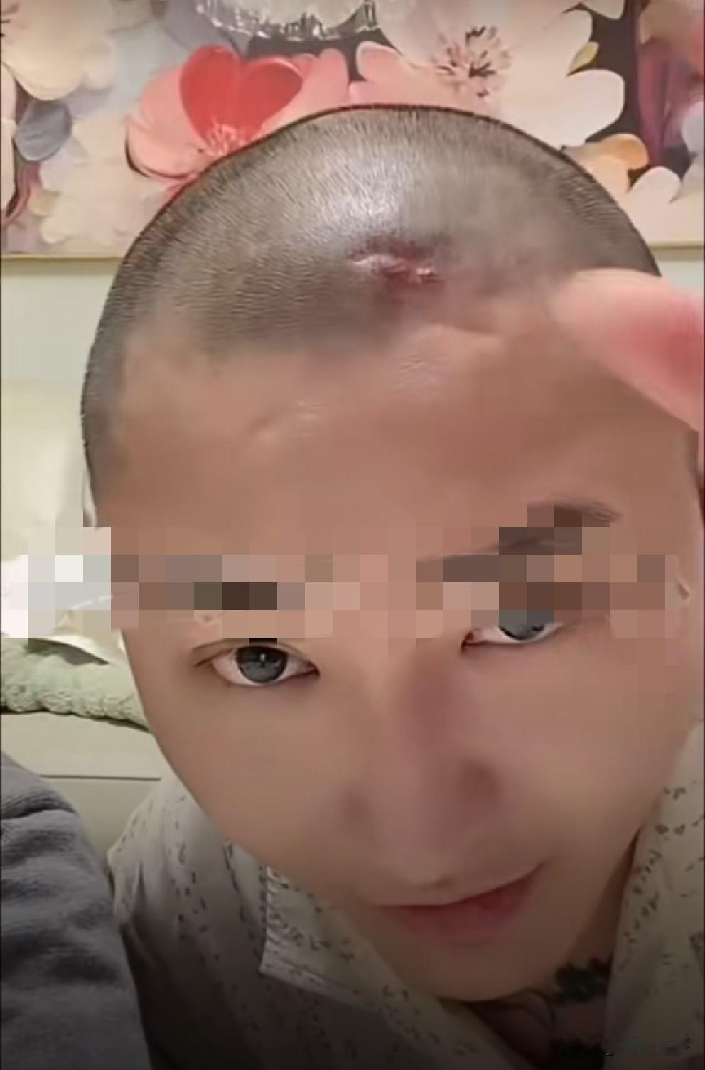 铁岭小辉展示头部微创疤痕，直指赵本六是罪魁祸首！

            铁岭