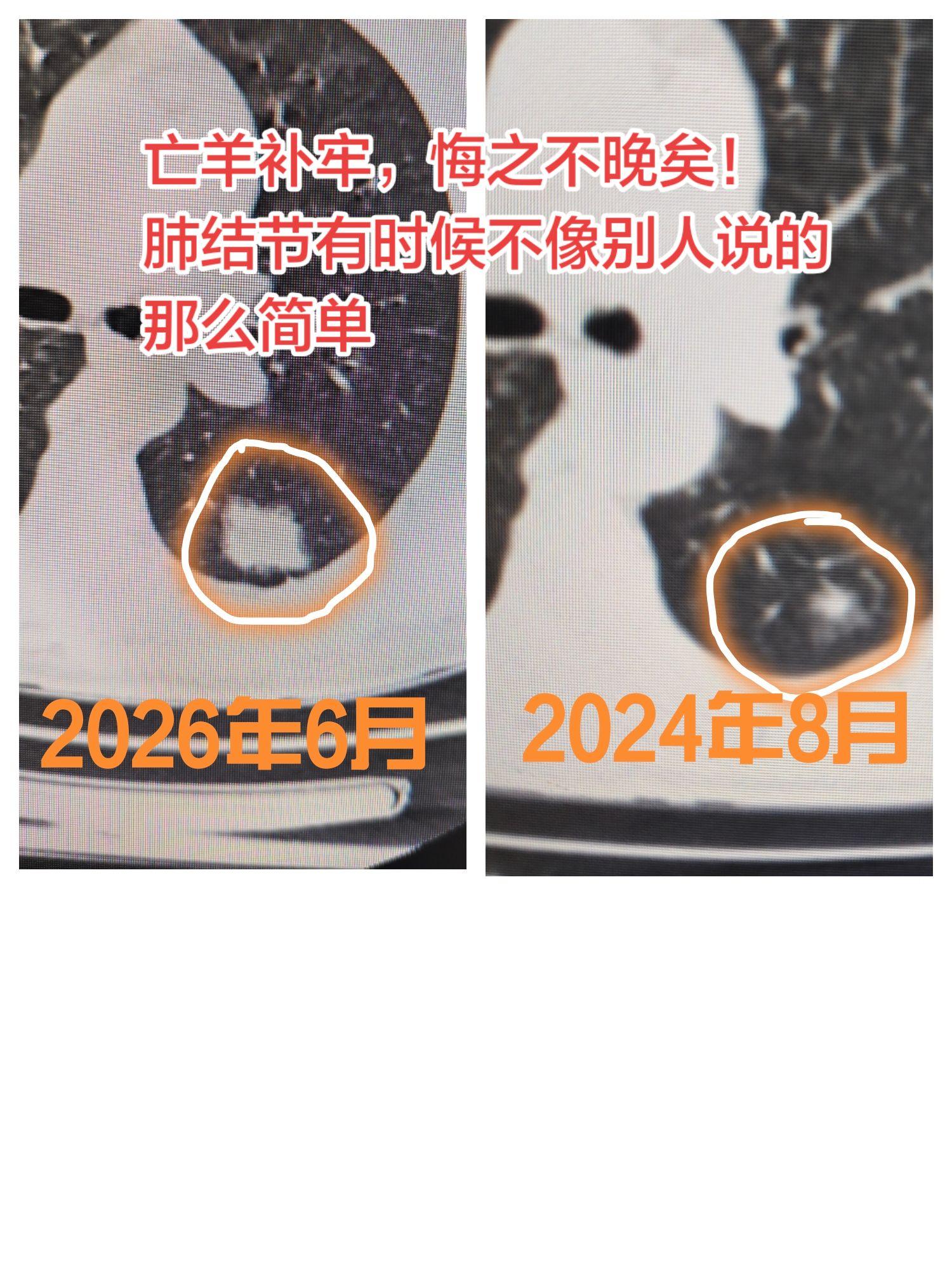 肺结节有时候没那么简单。亡羊补牢，悔之不晚矣！ 肺结节有时候不像别人说的那么简单