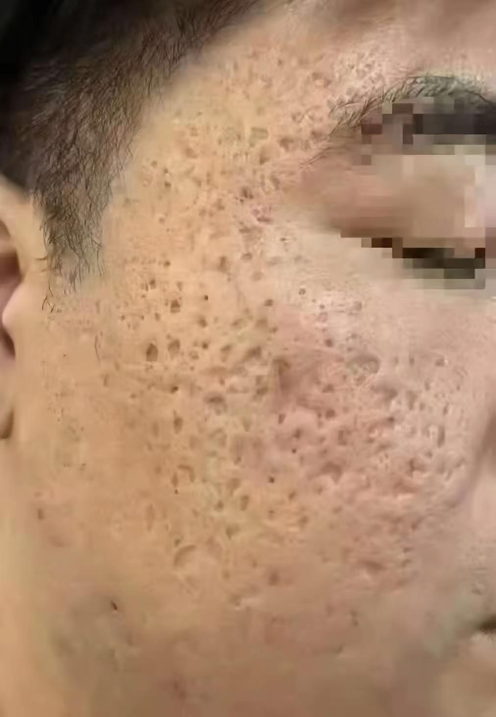 脸长成月球坑，该怎么办？