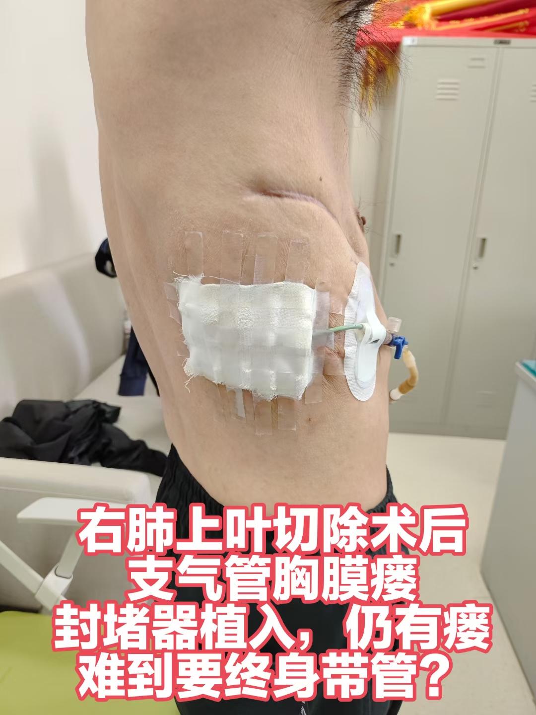 右肺上叶切除术后支气管胸膜瘘封堵后微创修。长春病友，右肺上叶切除术后，支气管胸膜瘘，封堵器植入，微创修复术后一月，在家复查CT，我们远程随访，不辞辛苦给与病友最大的照顾。