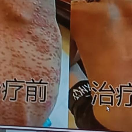 皮肤病难调理，很多时候真得怪自己“管不住嘴”。饮食对皮肤病影响极大，像面粉和糖类