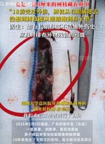活久见！9月9日广东一男子常年鼻塞和流鼻血，去了无数次医院，医生都说是鼻窦炎，但