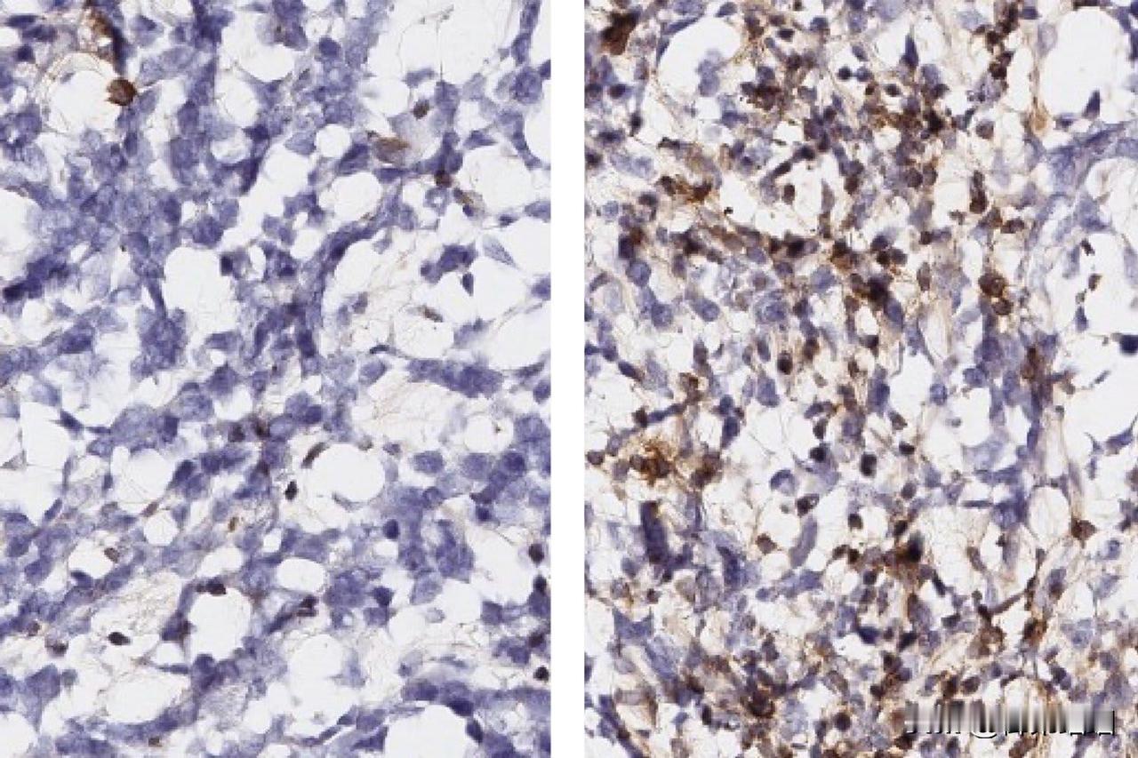 麻省理工学院研究人员发现胶质母细胞瘤的新免疫治疗靶点

麻省理工学院研究人员在F