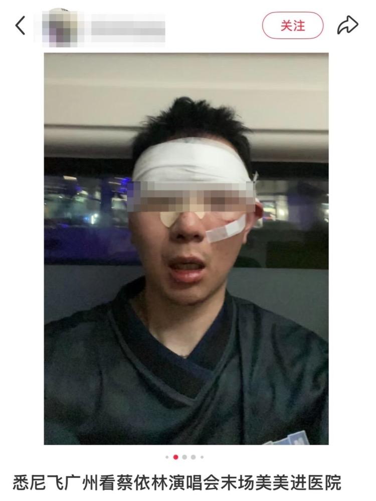 近日蔡依林广东演唱会出现意外状况，现场多名观众摔倒受伤，其中一位观众额头受伤缝了