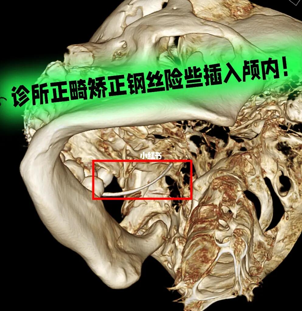 你还敢乱去矫正牙齿吗？