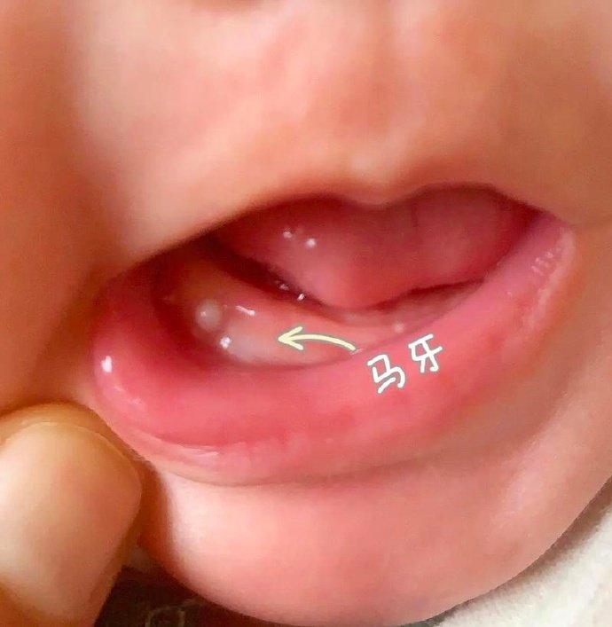 超六成家长不知道马牙
家有新生儿一定要看一眼这一篇

事件中，奶奶用碘伏擦到的是