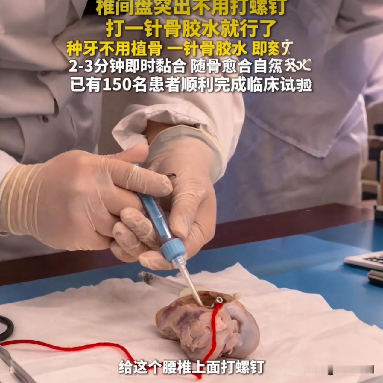 浙大“骨02”入中美审批通道，骨折不用打钢钉了！

想象一下，几百年来，无论是你