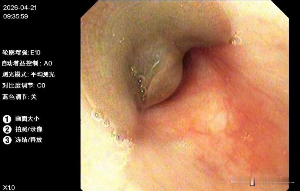 太可怕！云南临沧8岁的小林咳嗽了十几天，痰里带血，县医院抗感染治疗一点用都没有。