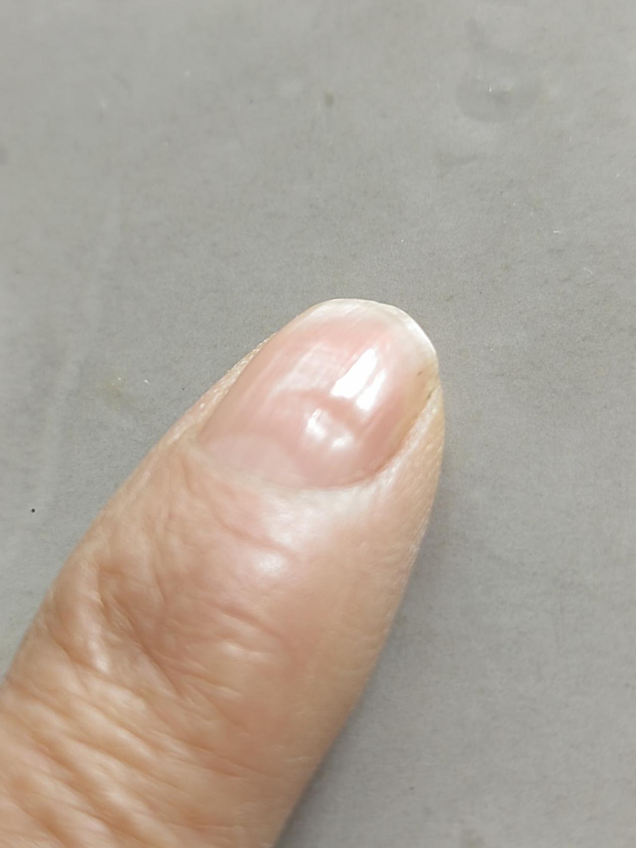 指甲这是怎么了？
食指指甲盖上，中间突然出现了一个小坑，抚摸着感觉凹凸明显，这是