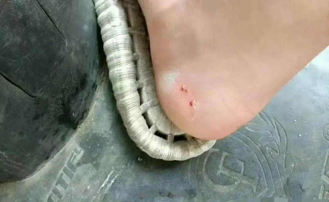 被小蛇蛇咬了，用上医院看看吗？我觉得没啥必要 