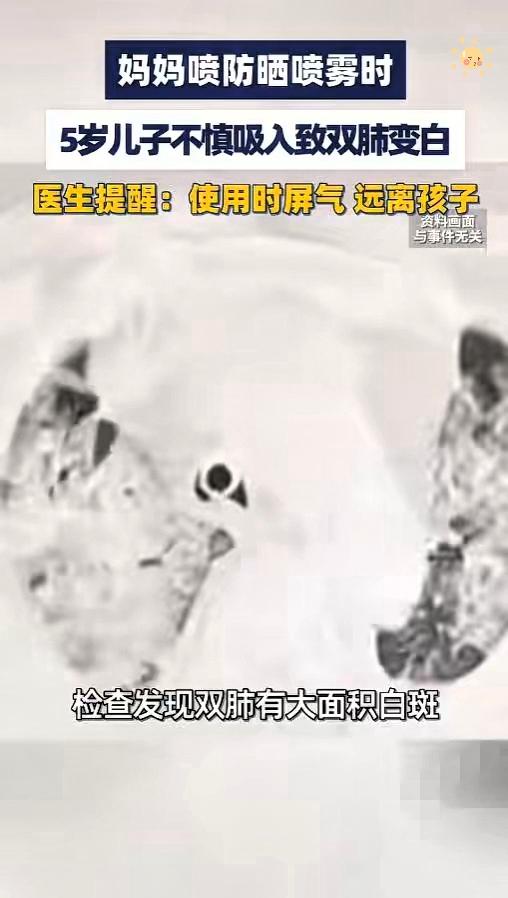 日常随手用的防晒喷雾，居然能伤到孩子肺部，看完真是捏了一把冷汗。郑州一名五岁男孩