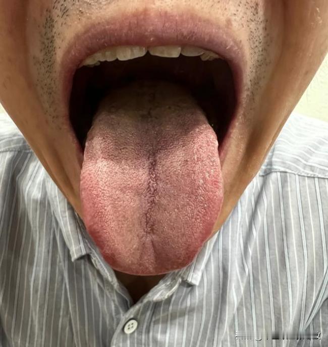 睡不好，时间短，腰膝酸困，身体被掏空，说的就是这种舌头

大哥主诉：时间太短了，