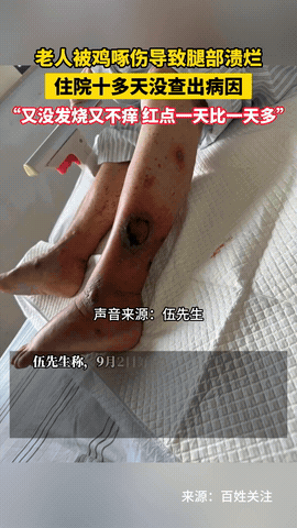 “悲剧还是发生了！”广东肇庆，一74岁老太在家里喂鸡期间，不慎被啄了一口！当时老