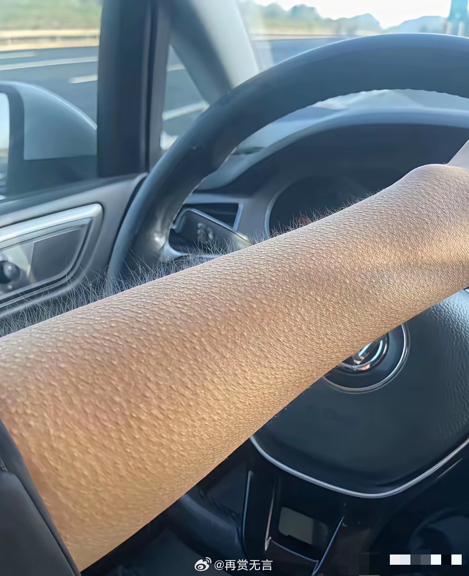 网约车司机，是得了艾滋病吗？这手上全是鸡皮疙瘩？ 