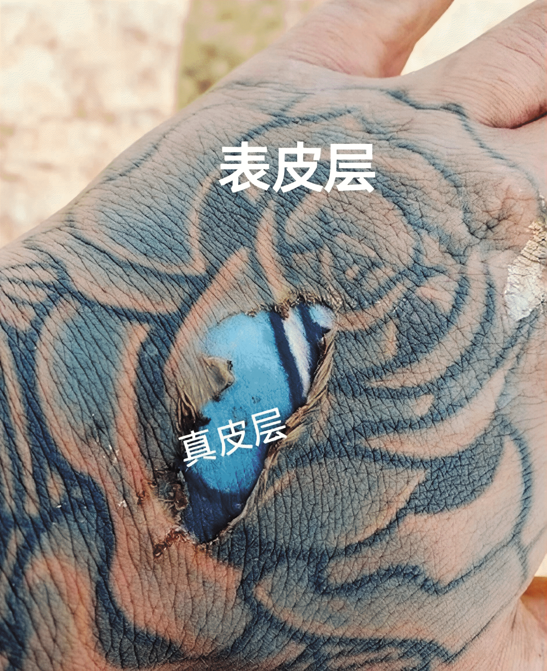 纹身！[发怒]
记住，针刺的深度很重要！

图片中，手背表皮已经剥脱，露出下面的