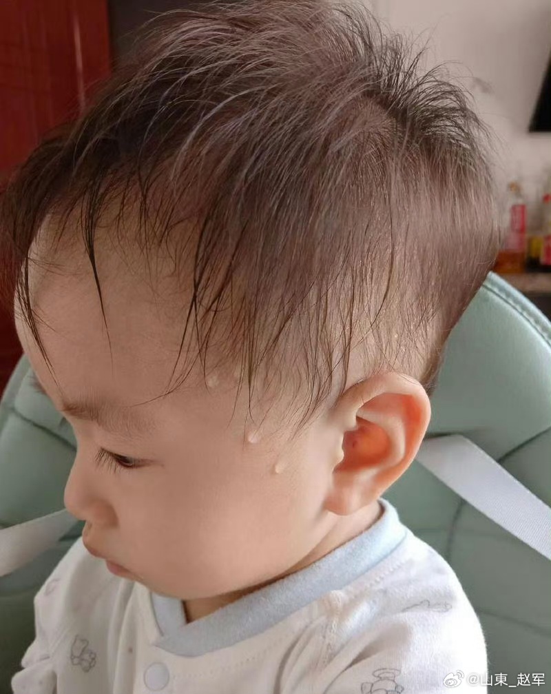 汗出在哪儿，火就在哪儿：人体异常出汗藏着中医经络智慧“汗出在哪儿，火就在哪儿”，