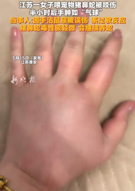 “差点没命还不弃养？”江苏淮安，女子被宠物猪鼻蛇咬伤后严重过敏，手肿成气球，抢救