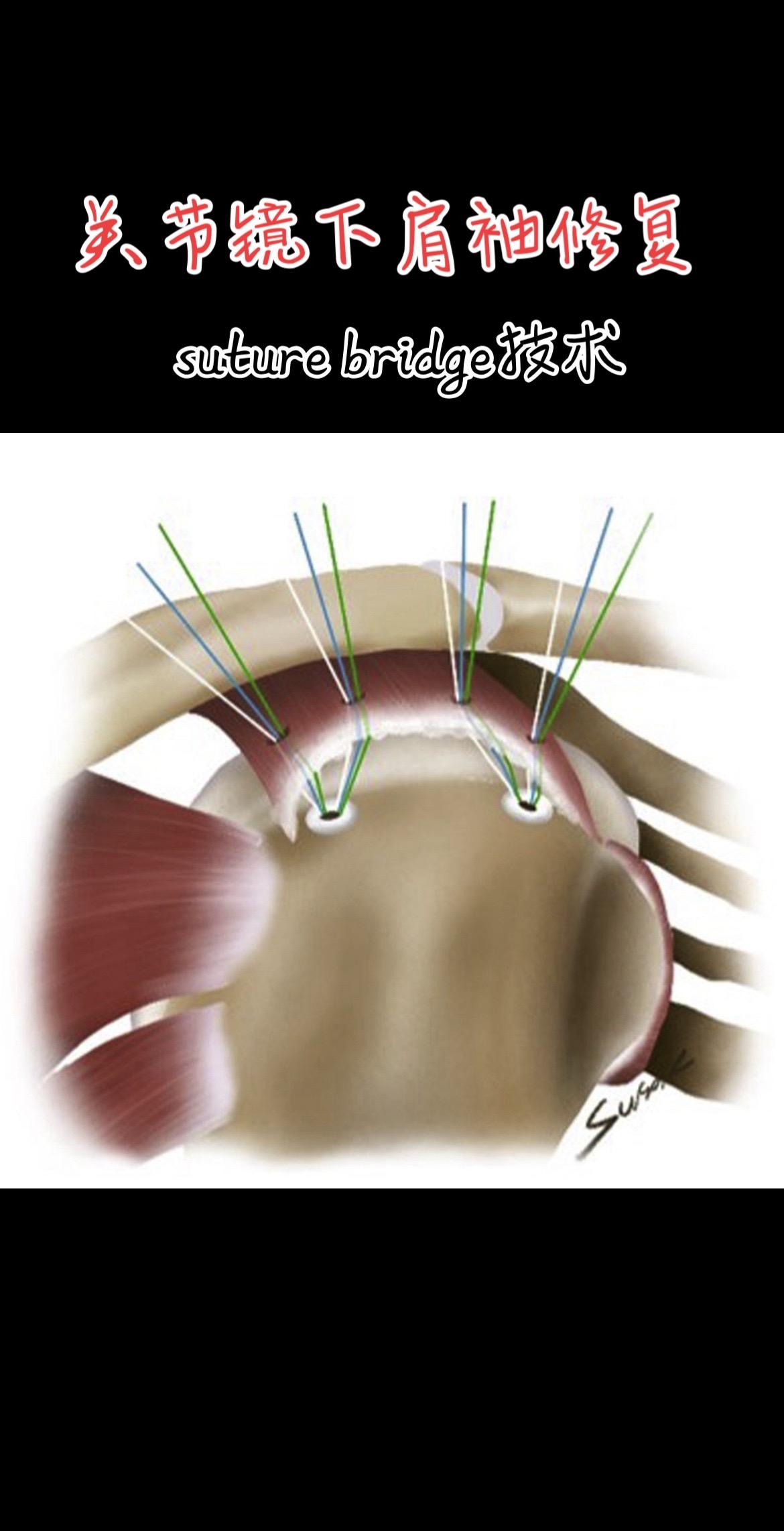关节镜下肩袖修复术。缝线桥（suture bridge技术）布线。Ar...