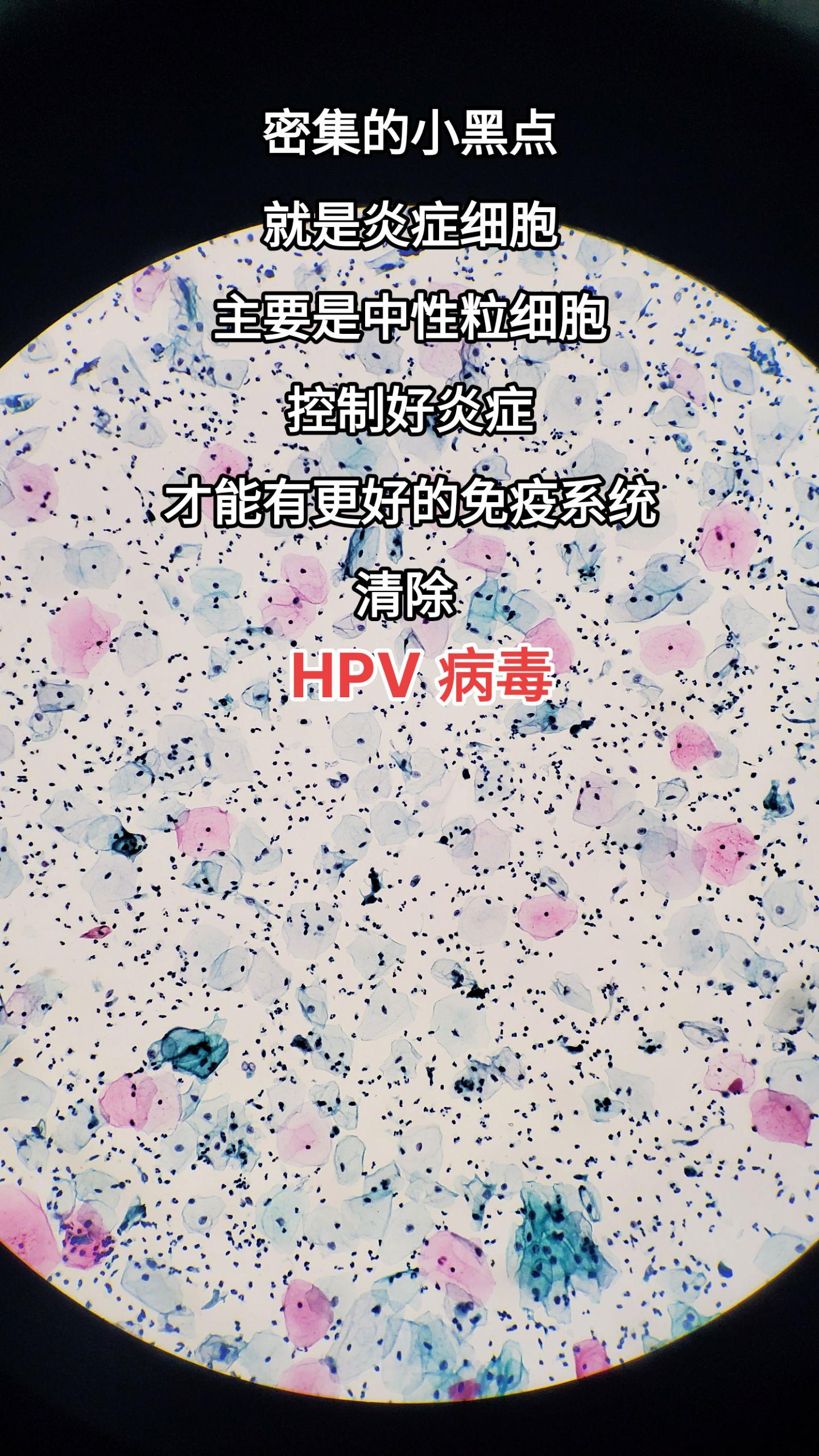 hpv感染