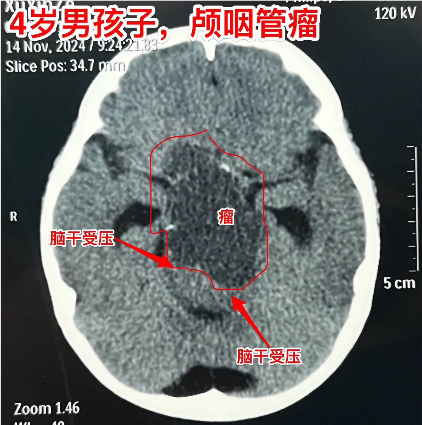 四岁男孩子右侧上下肢有点偏瘫症状！四岁苏州市男孩子出现视力下降、左侧眼...