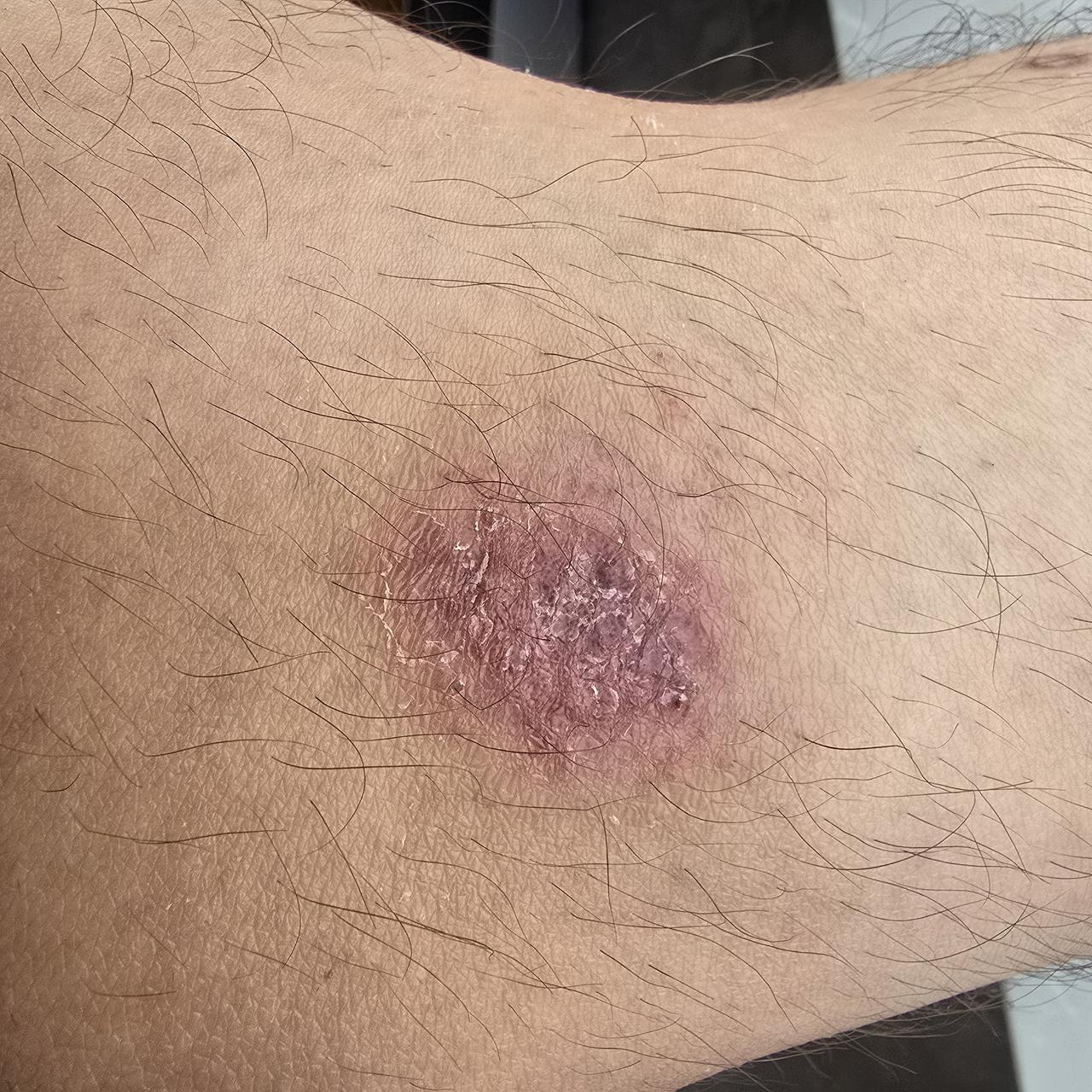 不听劝，自己的痛疼自己受。前三图，是孩子骑车摔的。后三图，是去年秋天住校被宿舍的