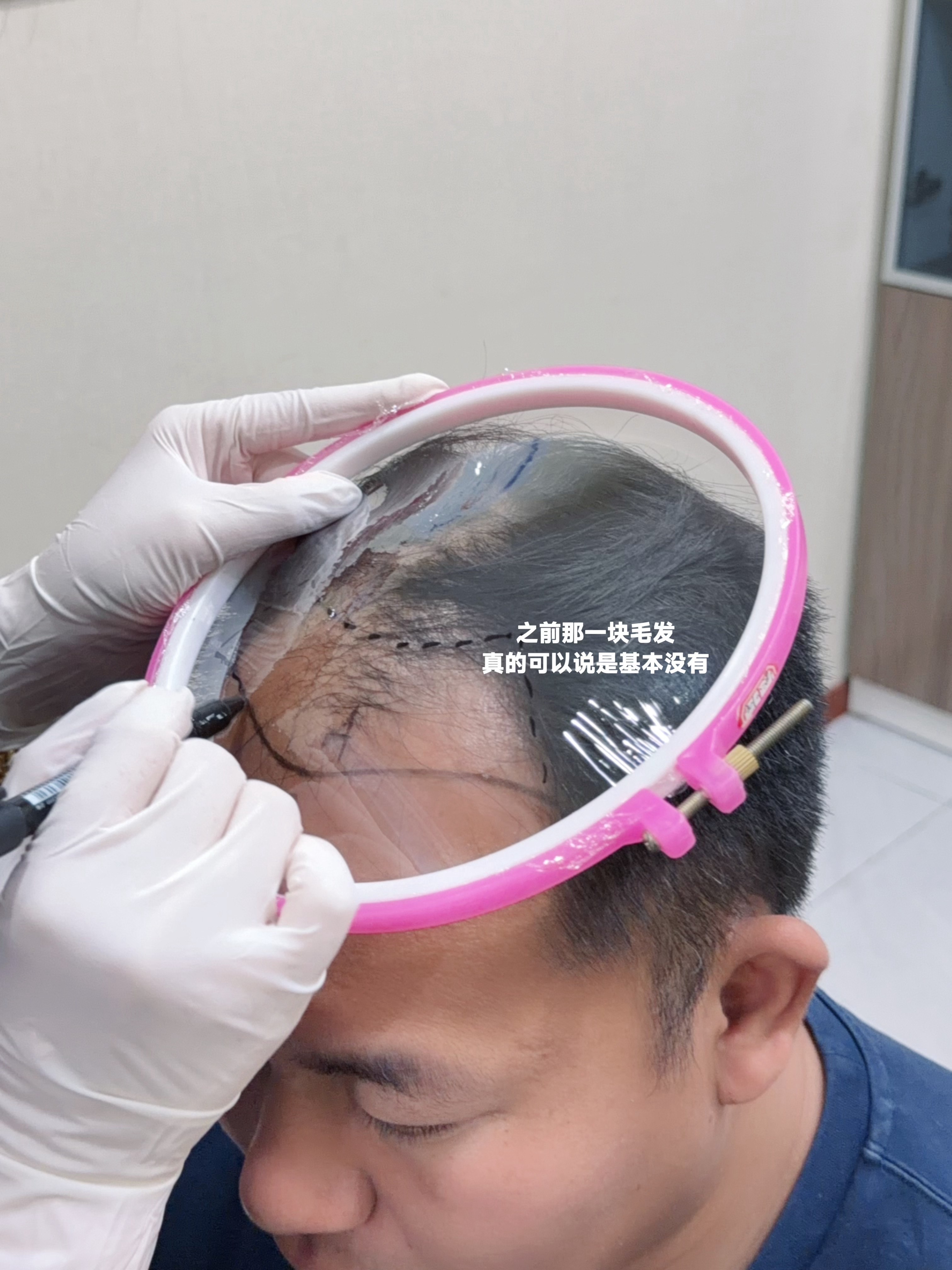 真快，种完都四个多月了。上次队友去理发💇，理发店老板还夸说效果真好都长出来了。