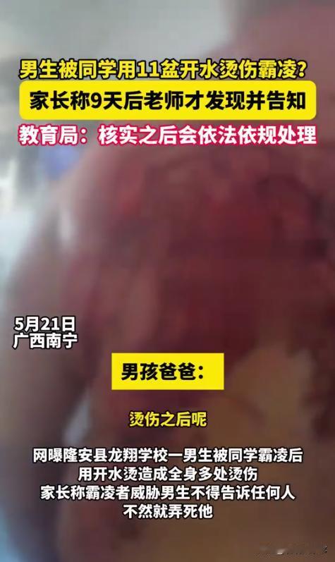 触目惊心！广西南宁，一男孩在上学期间遭遇同学的霸凌，甚至被恶意用开水烫伤，整个皮
