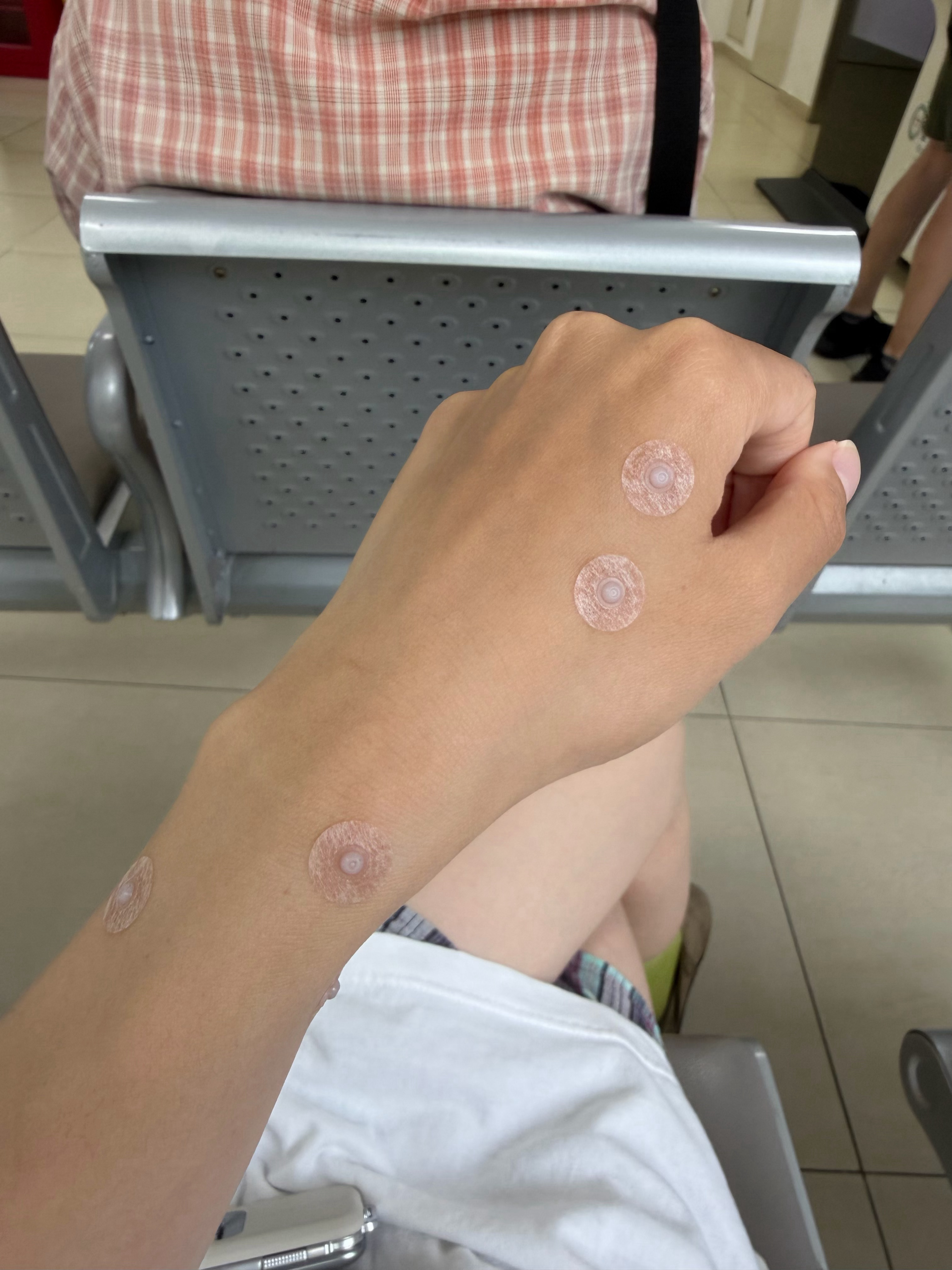 头一次感受中医治疗感冒发烧的皮内针，扎进去的时候有点疼，不过听说可以持续刺激穴位