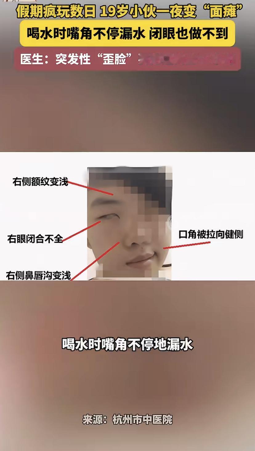 放假太疯狂!杭州19岁小伙一觉醒来脸歪了，医生：最近年轻人高发
杭州19岁的小齐