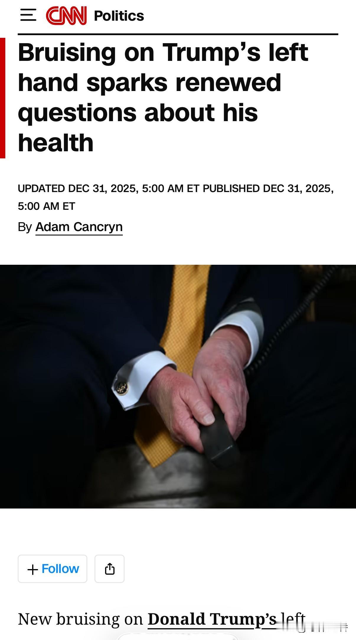 美媒通过川普左手上新的淤青，对这位已成为美国最年长总统的健康担忧。
   媒体称