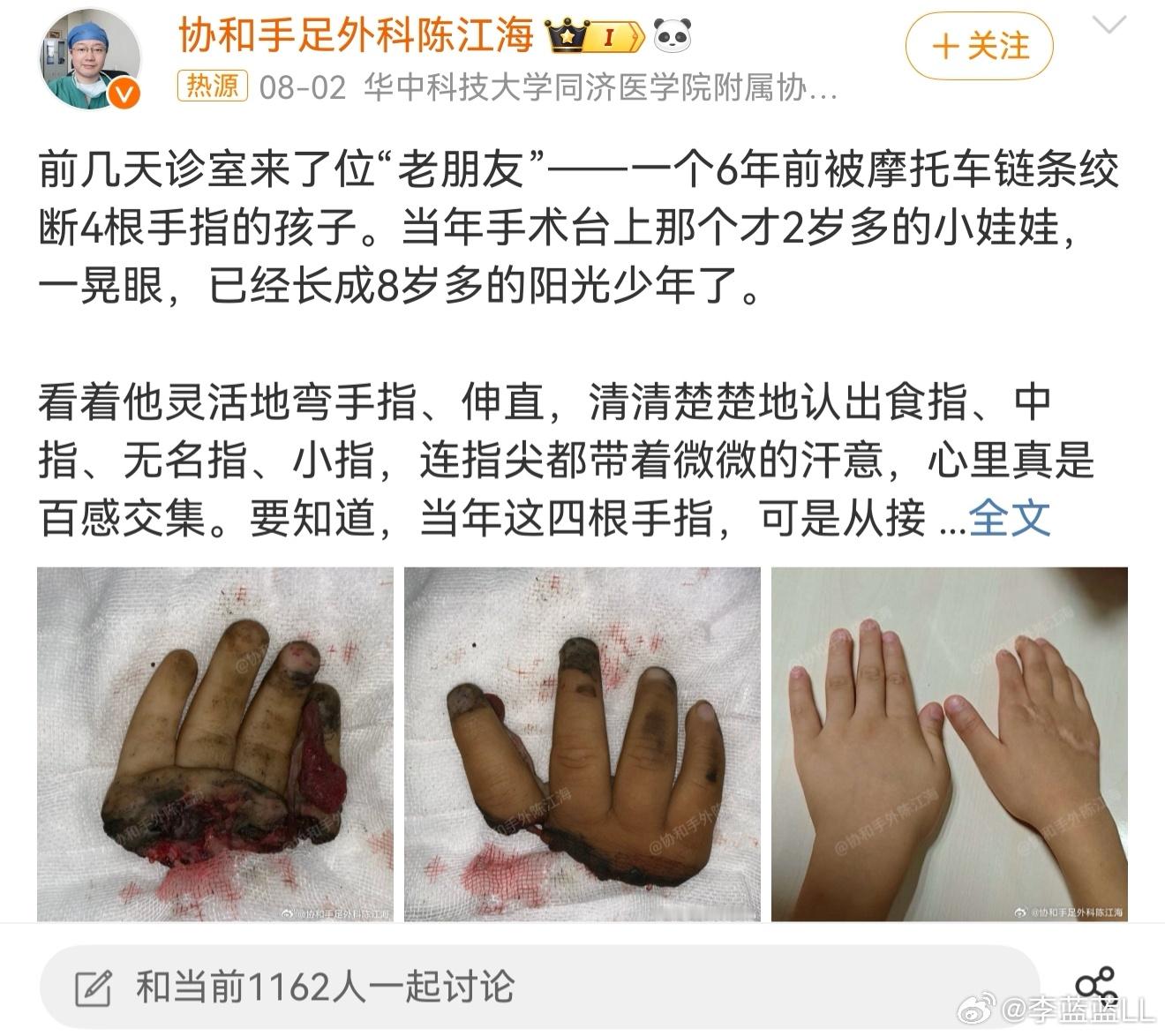 男童被绞断4根手指已恢复如初  天啊！这医学奇迹网友们看得都心潮澎湃的！这医生太