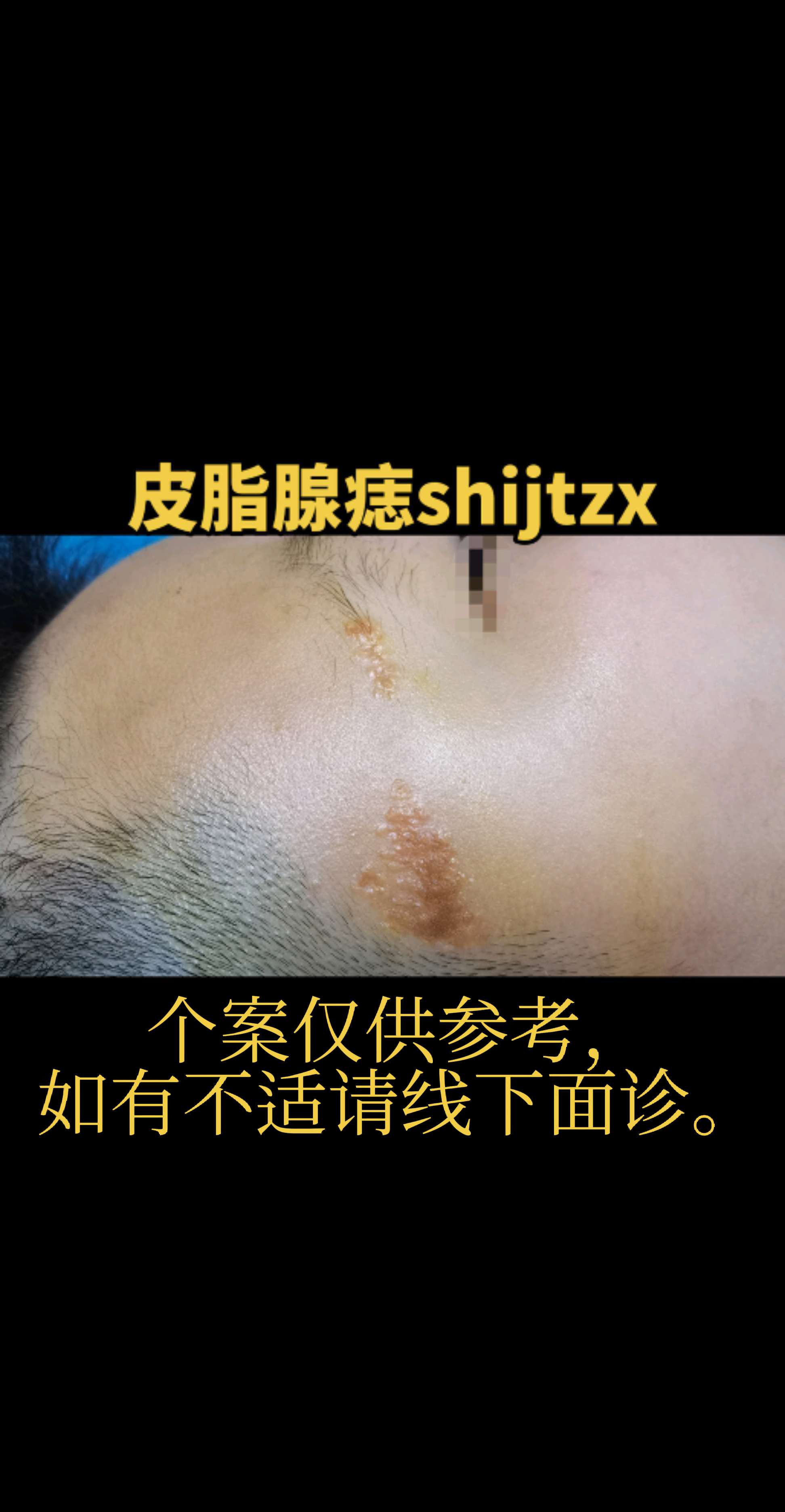 皮脂腺痣。面部皮脂腺痣切除分层减张缝合。