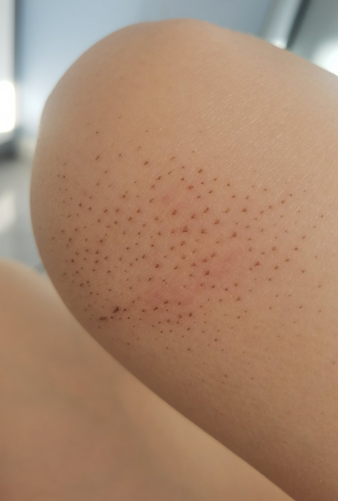 咱就是说这个大姐的搓澡伤害力也太强了，这么多天还不好