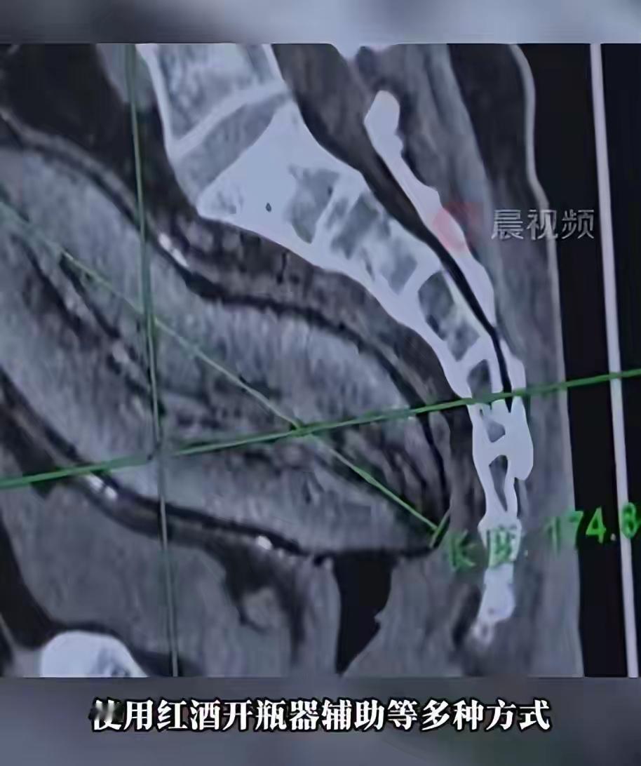 成都61岁男子将17cm红薯塞入肛门！半夜疼痛难忍被迫就医，医生：尺寸过大，得开