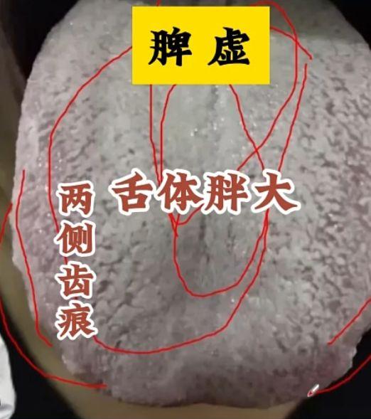 舌象分析：体内的寒邪 痰湿都比较重
这个舌头呈现出寒气四溢的特征，舌面宛如覆盖了