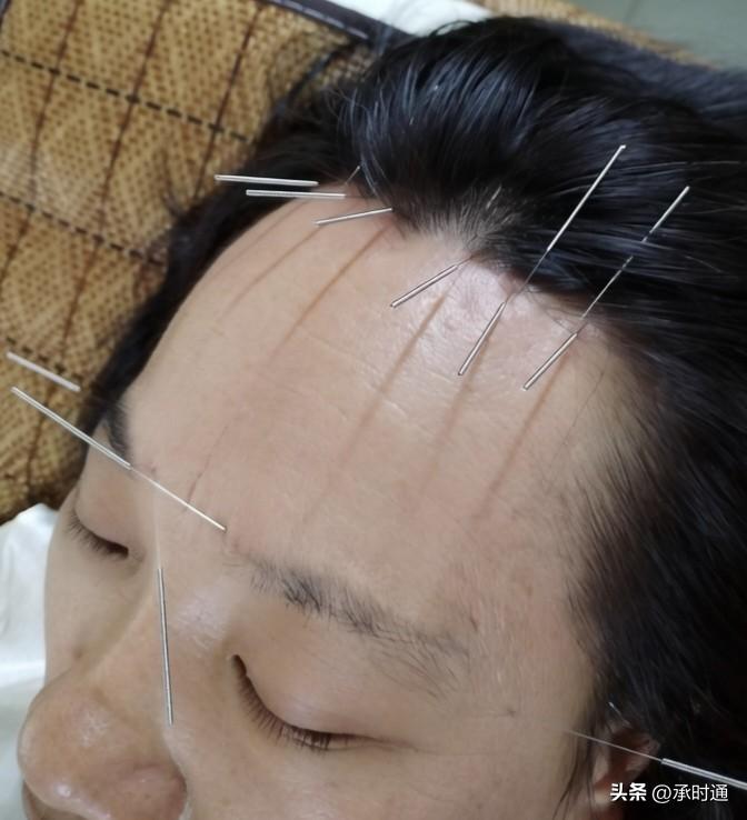 在针对高血压和消渴病（糖尿病）的针刺干预中，您是否碰到过以头部穴位（如图所示）作