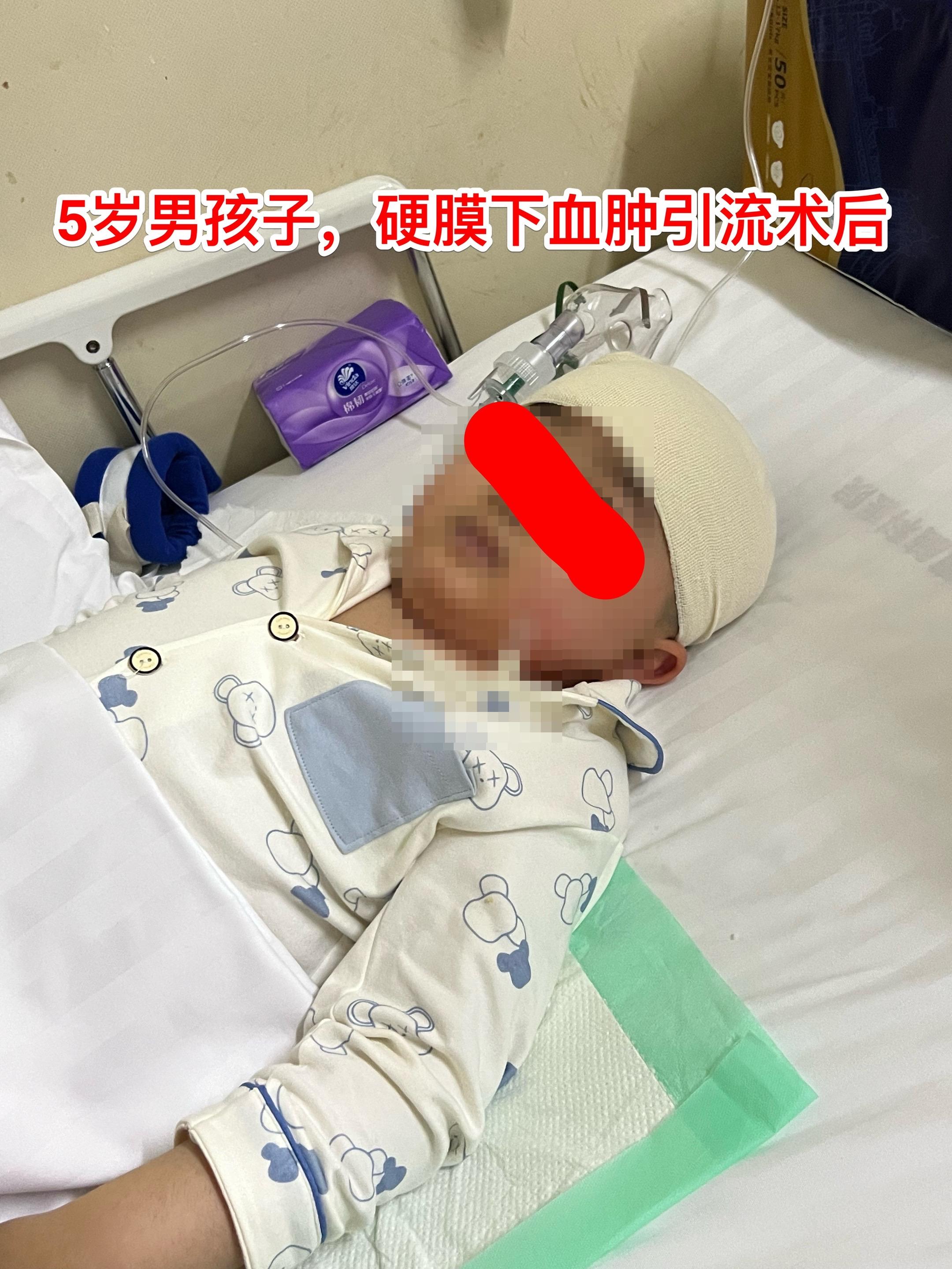 五岁男孩子双侧慢性硬膜下血肿。这个五岁男孩子，五个月前曾经在我科行颅咽...