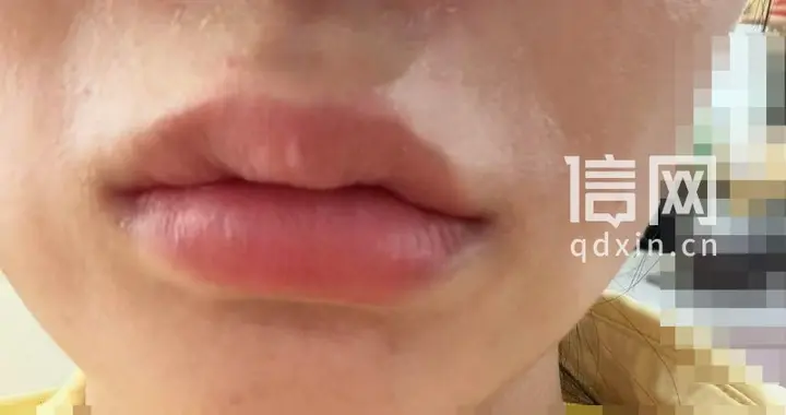 女子隆鼻后淤青眼肿，上海桉锘美说不用管、马应龙痔疮膏涂满 最终被公立医院诊断为并发症，面临毁容风险
