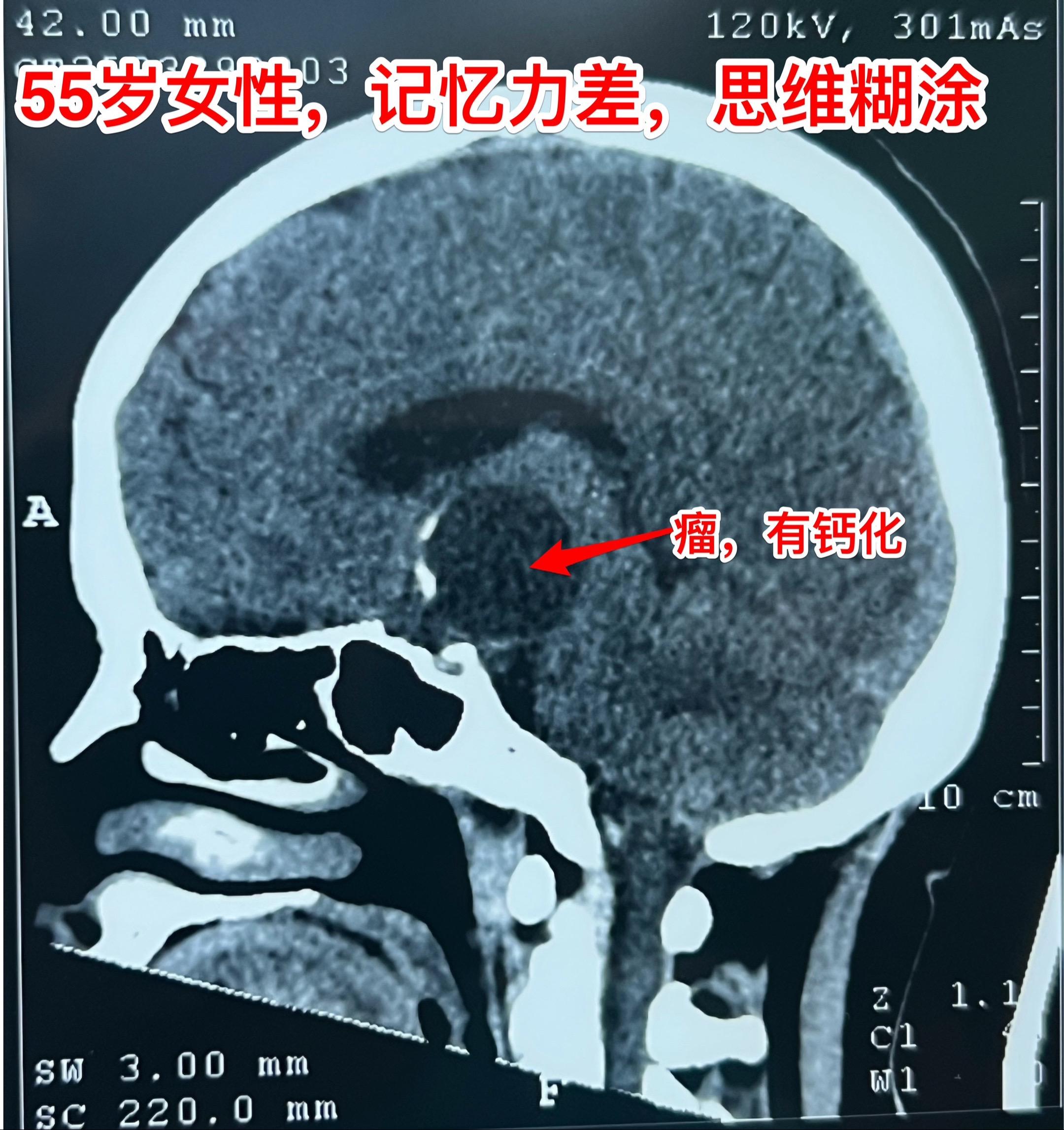 第一眼就诊断为颅咽管瘤，病理报告却不是。55岁女性因记忆力下降，有时思...