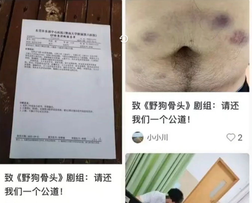 疑似野狗骨头群演受伤维权野狗骨头群演工作受伤，赔偿迟迟没有着落，看到这受伤的样子