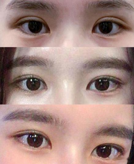 韩国双眼皮修复 宽降窄：全切+提肌 