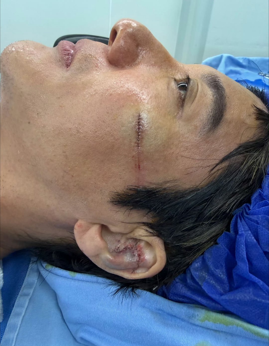 王力宏缝了39针耳朵软骨被撞碎，缝了27针，脸上还12针，加起来整整39针。王力