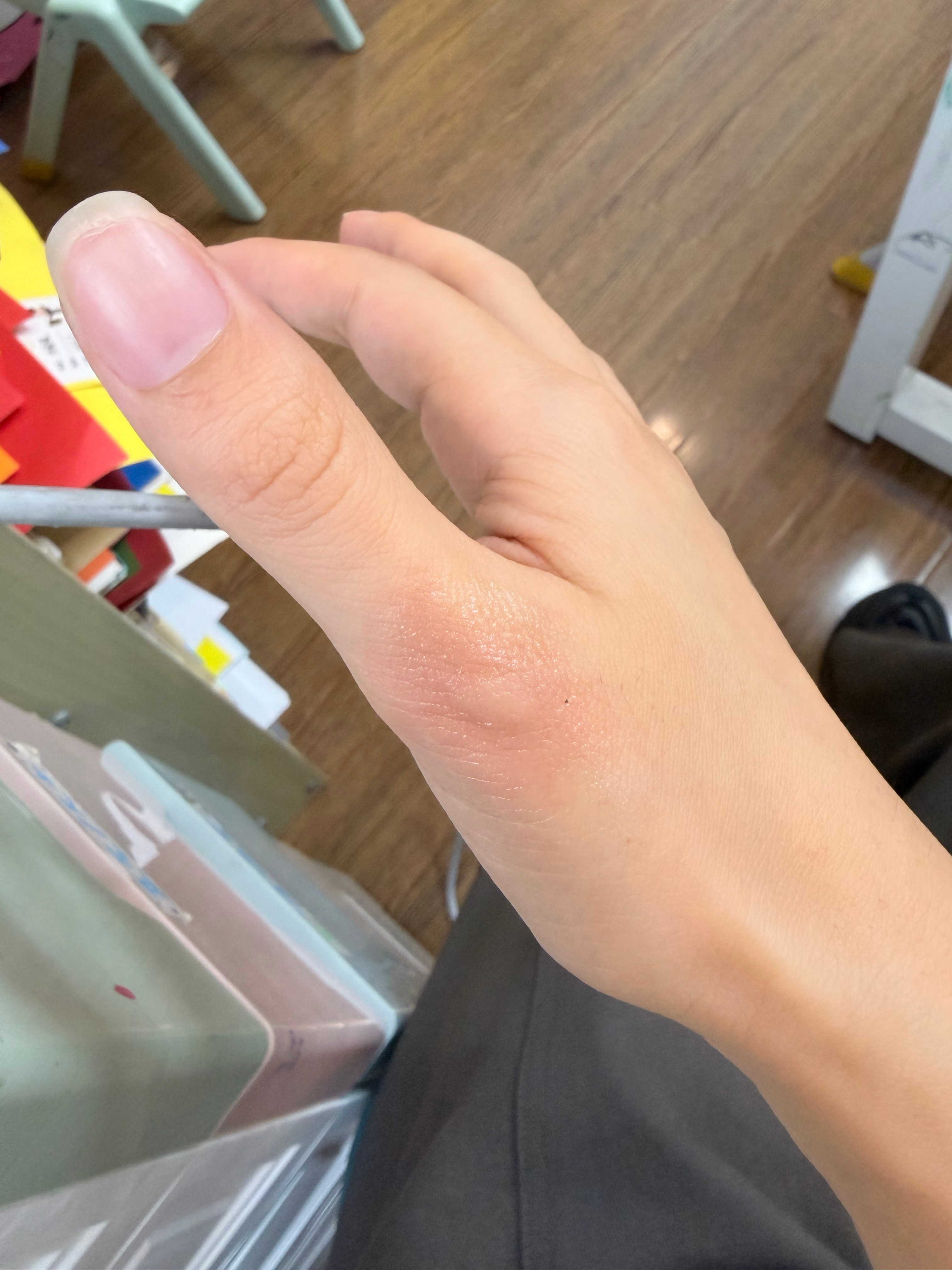 边走路边玩手机来上班的，没看见什么咬的，就已经肿起来了 