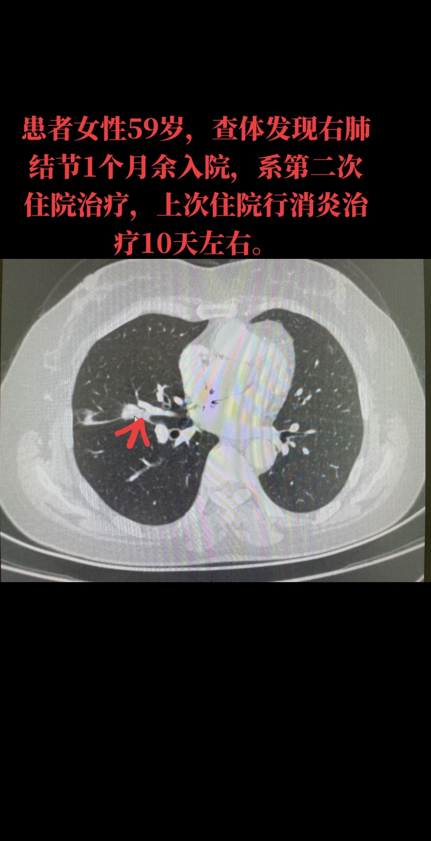 病例分享：右肺上、中叶腺癌，术后病理结果回归：右肺中叶中低分化腺癌，微...