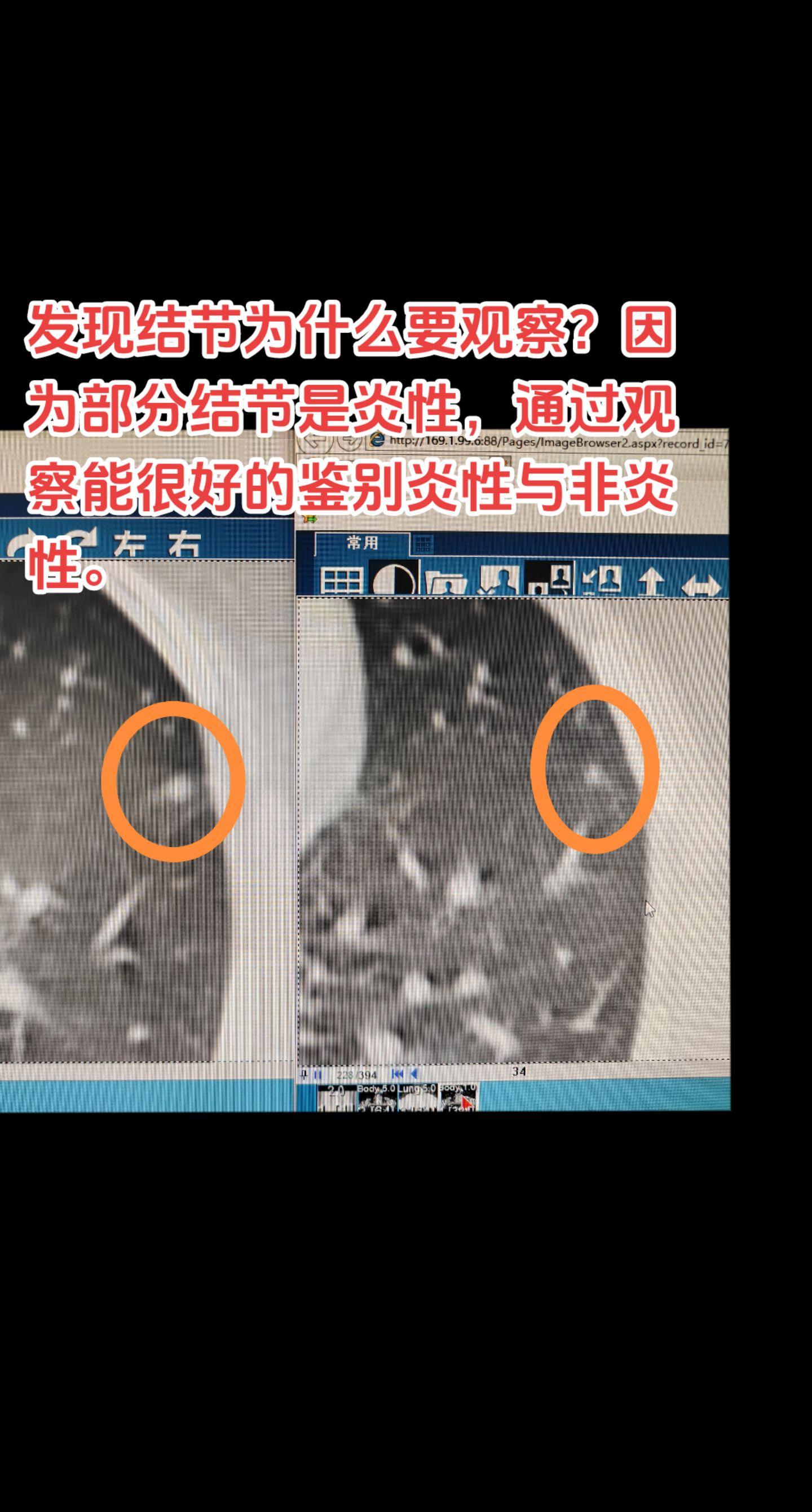 发现结节为什么要观察？因为部分结节是炎性，炎性结节可以在一定的时间消失或缩小，通过观察能很好的鉴别炎性与非炎性。