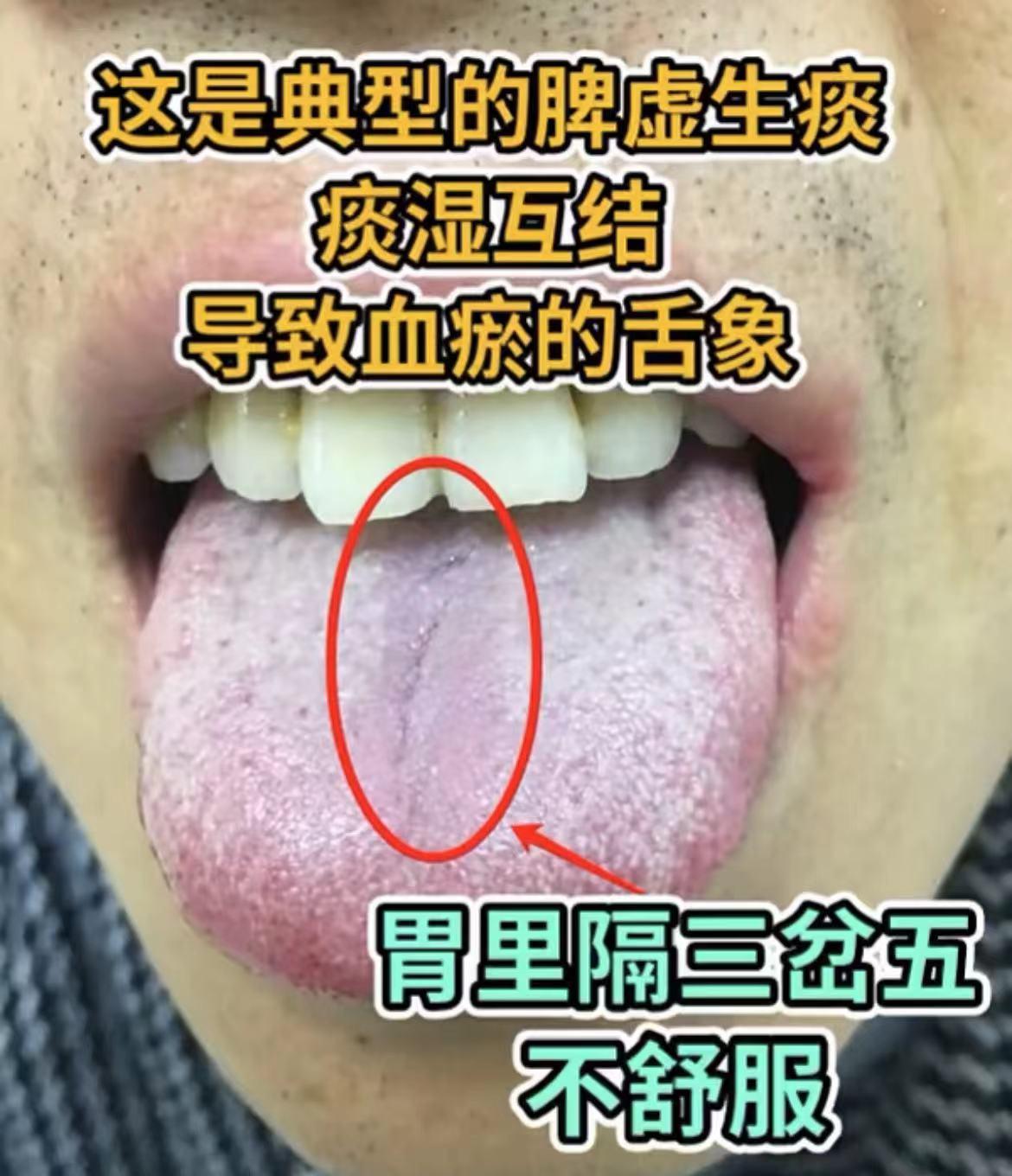 分享！大分享！舌诊大分享！[玫瑰][玫瑰][玫瑰][玫瑰]
这些全是20多岁的孩