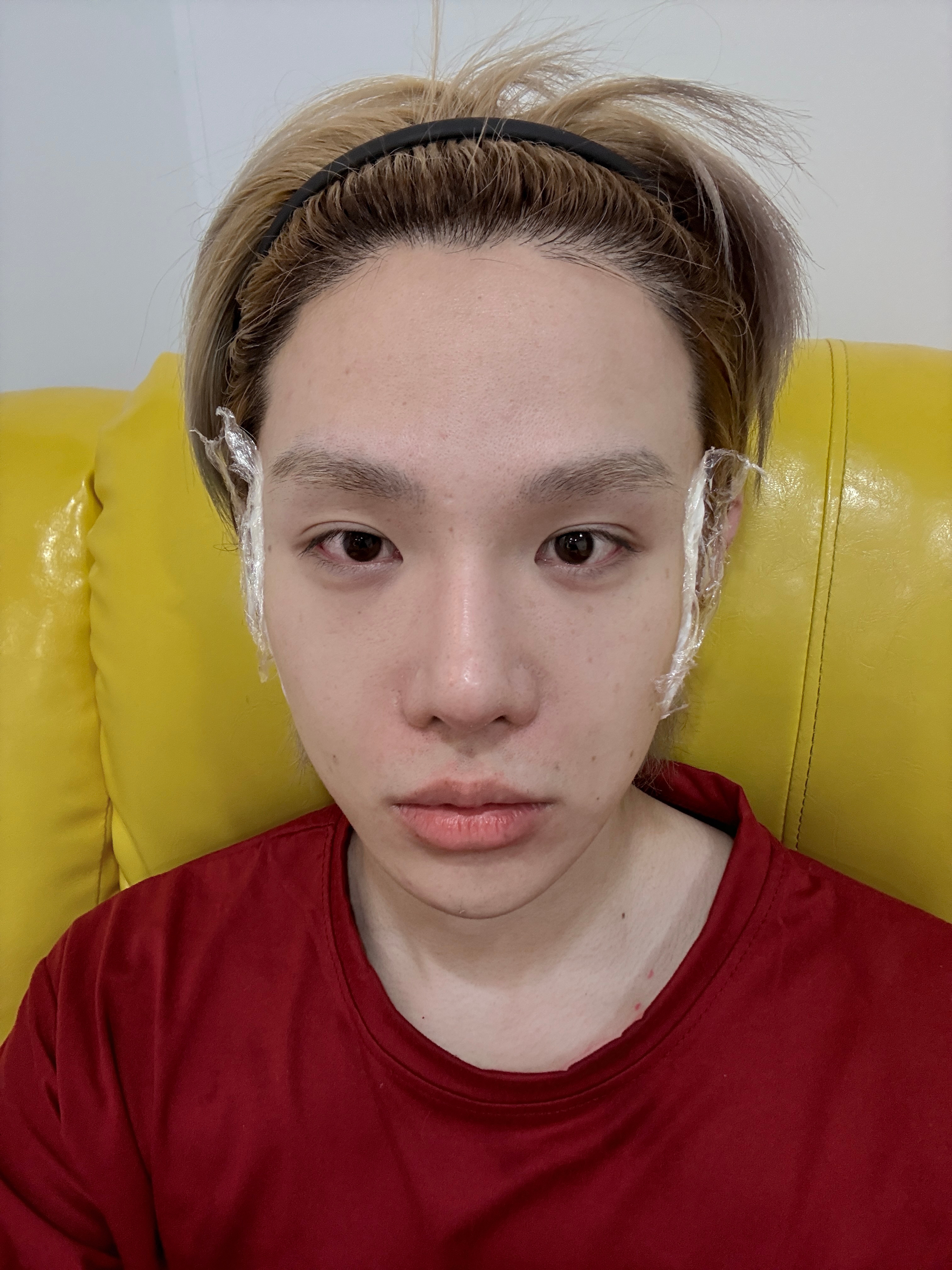 玩完卸个妆就来打针了 这次打耳前韧带 