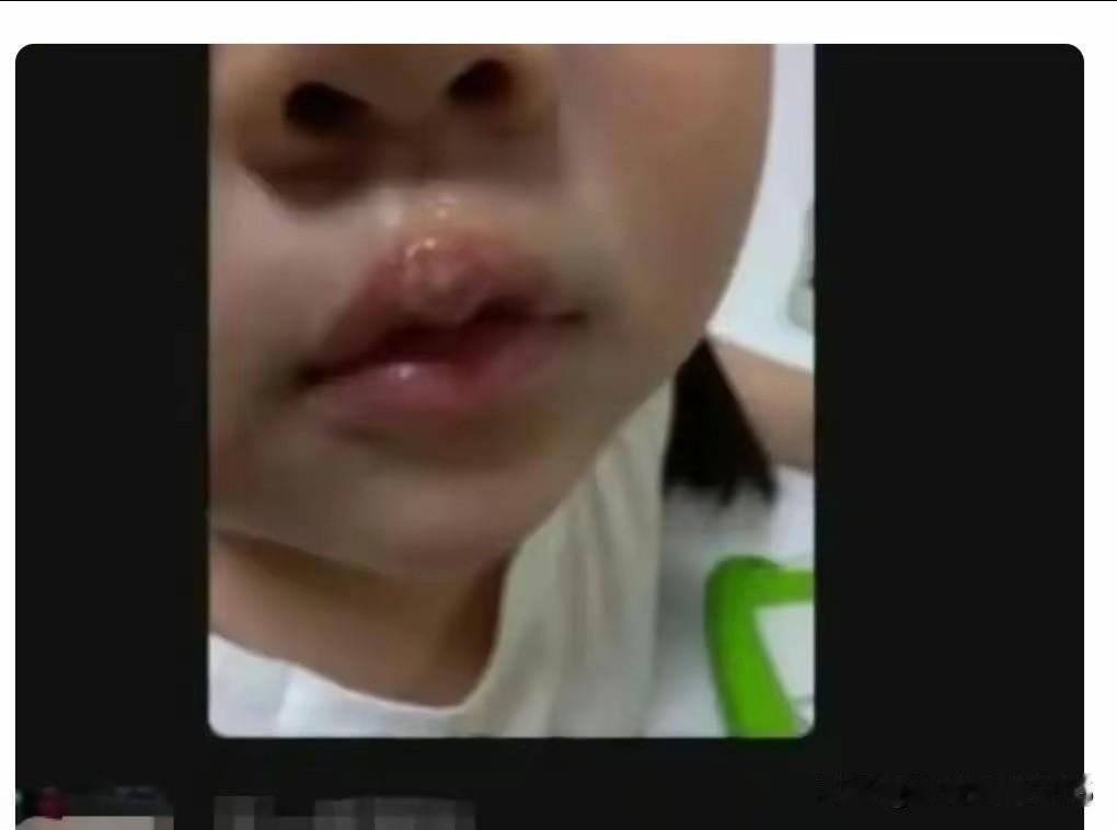 教师用高温热熔胶烫幼儿的嘴，这不是“不当对待”，这是在犯罪！这行为实在是太恶劣了